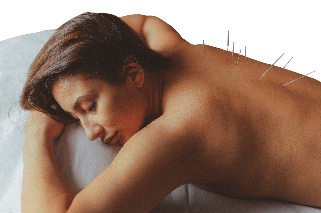 Acupuntura
